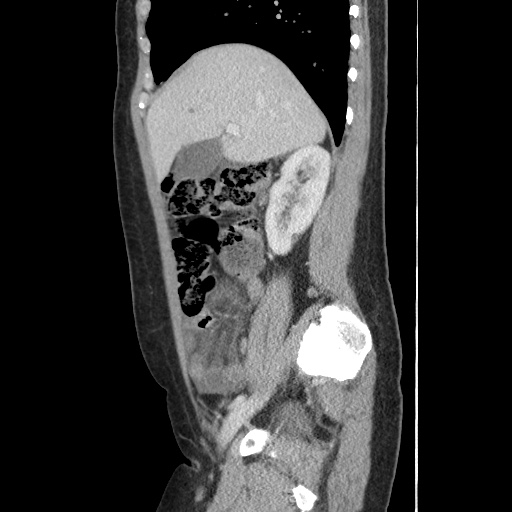 Closed loop small bowel obstruction due to trans-omental herniation (Radiopaedia 35593-37109 C 22).jpg