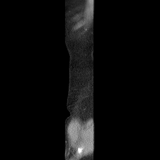 Closed loop small bowel obstruction due to trans-omental herniation (Radiopaedia 35593-37109 C 3).jpg
