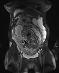 File:Closed loop small bowel obstruction in pregnancy (MRI) (Radiopaedia 87637-104031 Coronal T2 fat sat 21).jpg