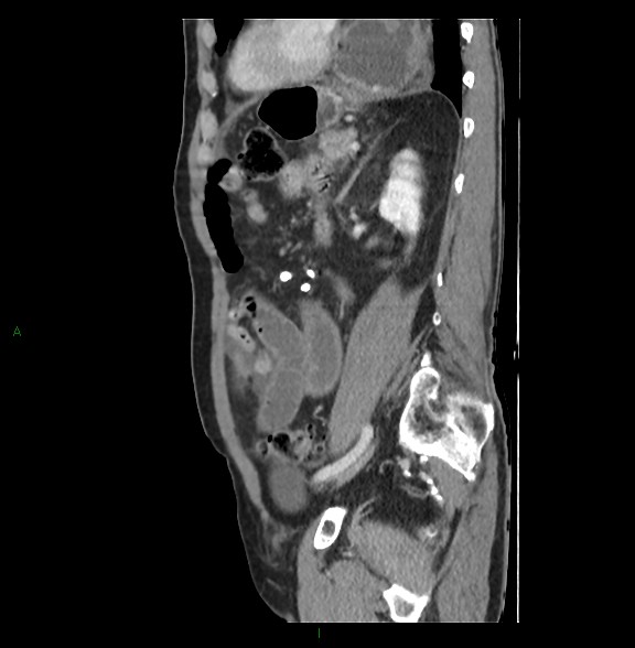 File:Closed loop small bowel obstruction with ischemia (Radiopaedia 84180-99456 C 62).jpg