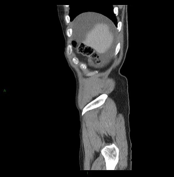 Closed loop small bowel obstruction with ischemia (Radiopaedia 84180-99456 C 9).jpg