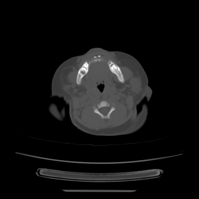 Cloverleaf skull (Radiopaedia 91901-109710 Axial bone window 27).jpg