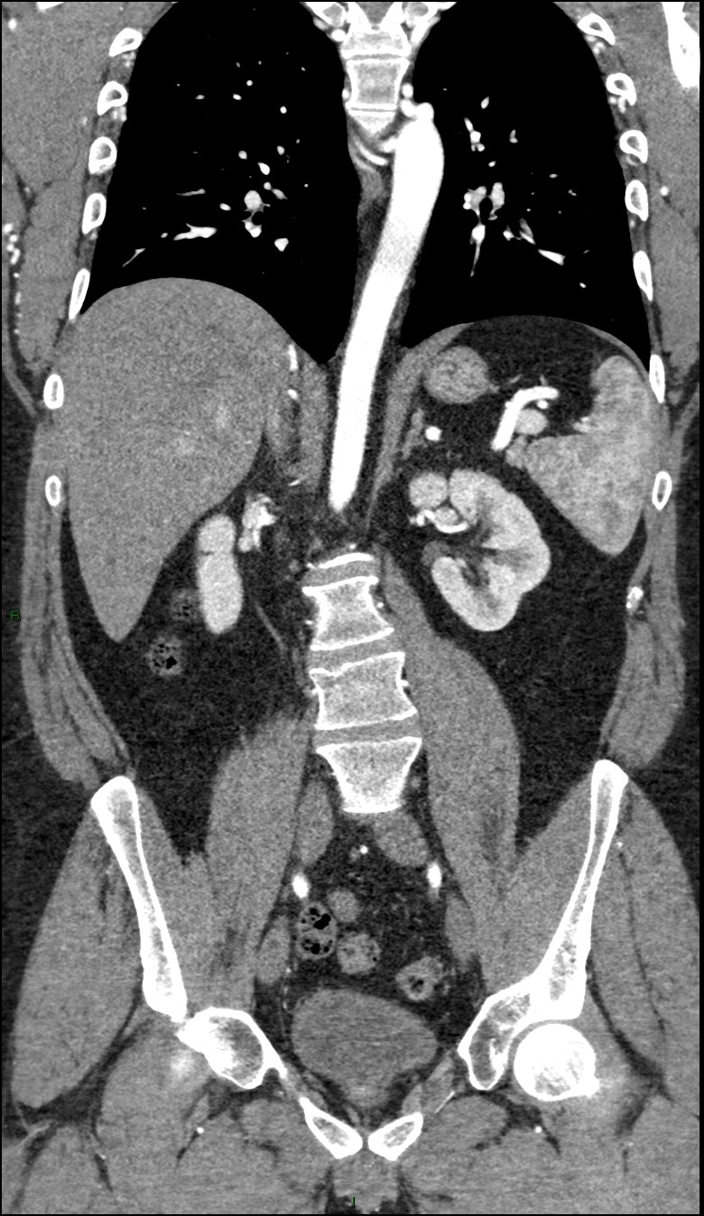 Coarctation of the aorta (Radiopaedia 74632-88521 B 142).jpg