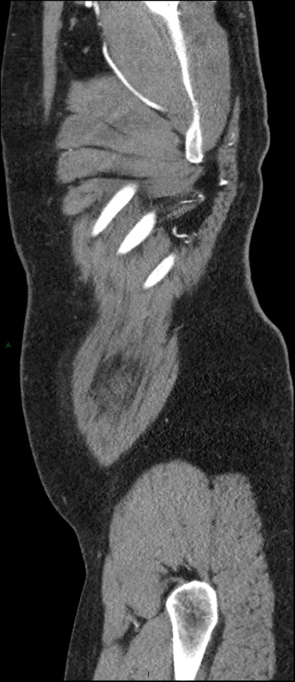 Coarctation of the aorta (Radiopaedia 74632-88521 C 314).jpg