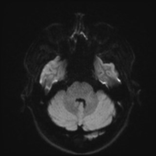 Cochlear incomplete partition type III associated with hypothalamic hamartoma (Radiopaedia 88756-105498 Axial DWI 51).jpg