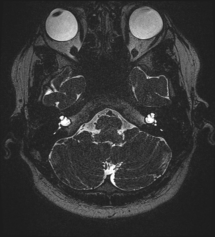 Cochlear incomplete partition type III associated with hypothalamic hamartoma (Radiopaedia 88756-105498 Axial T2 60).jpg