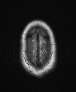 File:Colloid cyst (Radiopaedia 44510-48181 Axial FLAIR 27).png