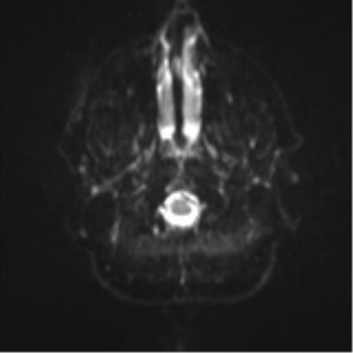 File:Colloid cyst (Radiopaedia 53164-59125 Axial DWI 2).png