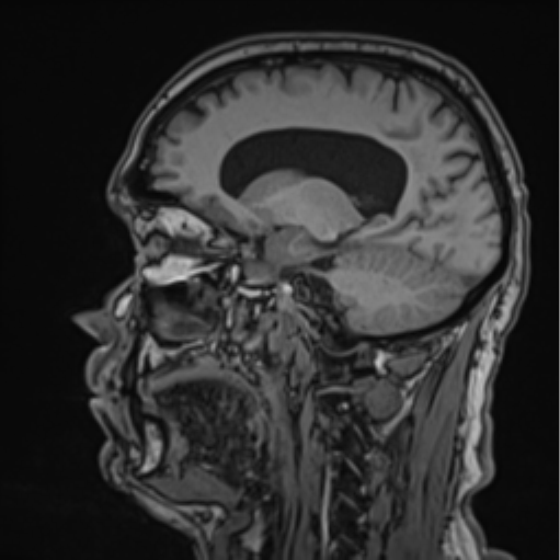 File:Colloid cyst of the third ventricle (Radiopaedia 86571-102662 Sagittal T1 48).png