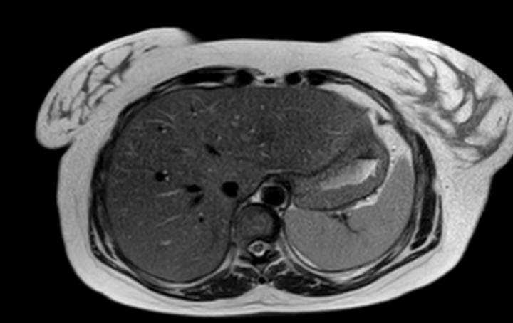 Colon adenocarcinoma with Krukenberg tumors, advanced pregnancy (Radiopaedia 67279-76645 Axial T2 72).jpg