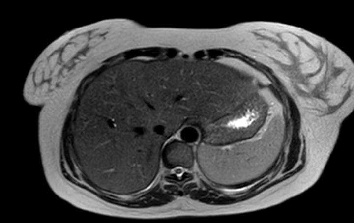 Colon adenocarcinoma with Krukenberg tumors, advanced pregnancy (Radiopaedia 67279-76645 Axial T2 73).jpg