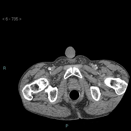 File:Colonic cancer (ultrasound and TC imaging) (Radiopaedia 50346-55713 A 153).jpg