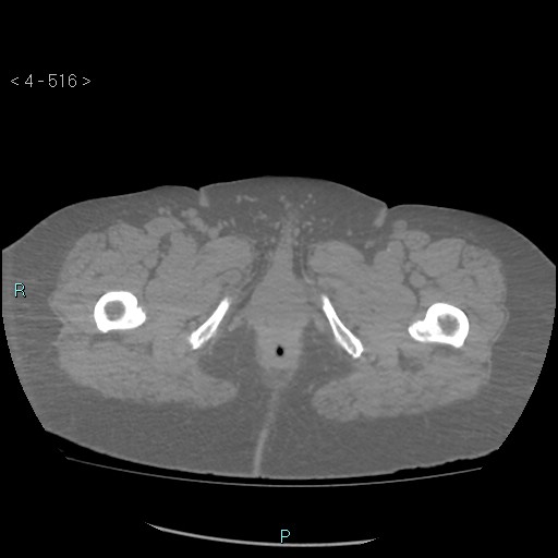 File:Colonic lipomas (Radiopaedia 49137-54244 Axial bone window 230).jpg