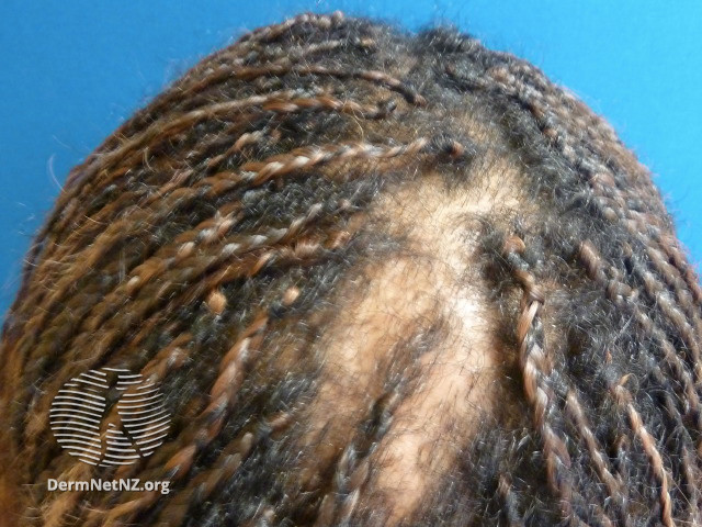 File:DermNet NZ hair-nails-sweat-ccca-2.jpg