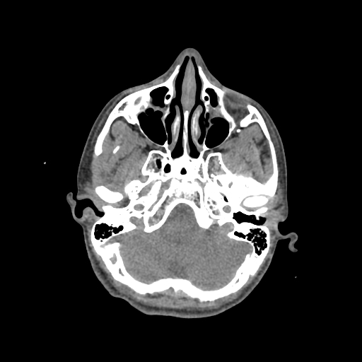 Nasal pyogenic granuloma (lobular capillary hemangioma) (Radiopaedia 85536-101244 Axial non-contrast 72).jpg
