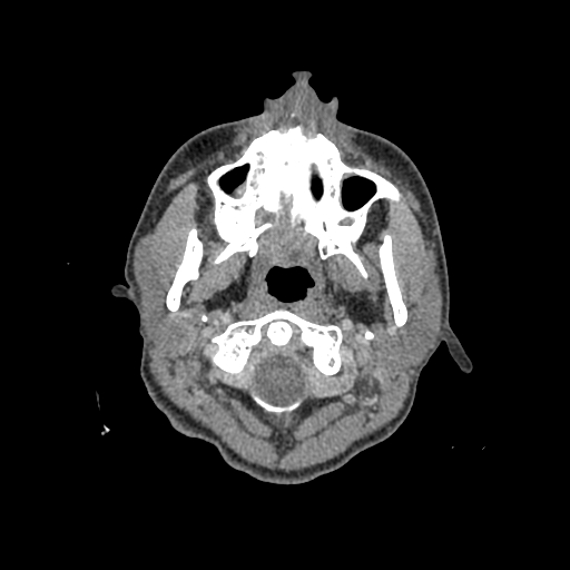 File:Nasal pyogenic granuloma (lobular capillary hemangioma) (Radiopaedia 85536-101244 C 3).jpg