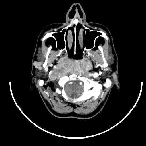 File:Nasopharyngeal carcinoma - infiltrating the clivus (Radiopaedia 62583-70875 Axial Post contrast 18).jpg