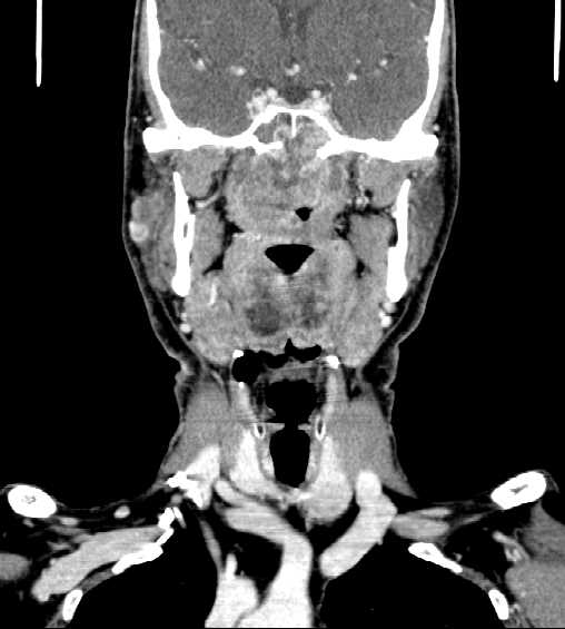 File:Nasopharyngeal carcinoma - infiltrating the clivus (Radiopaedia 62583-70875 D 19).jpg