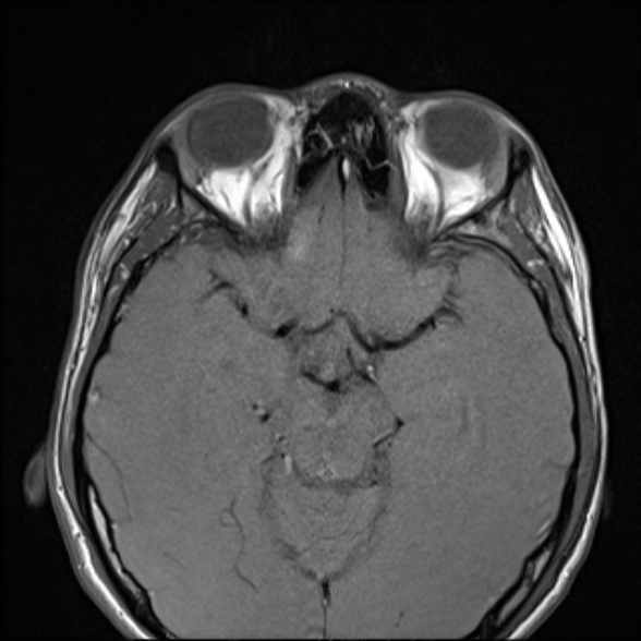 File:Nasopharyngeal carcinoma with skull base invasion (Radiopaedia 53415-59485 Axial T1 14).jpg