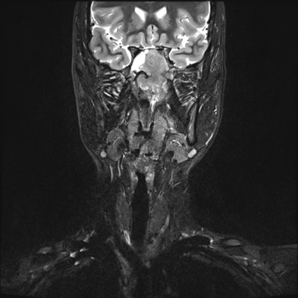 Nasopharyngeal carcinoma with skull base invasion (Radiopaedia 53415-59485 Coronal T2 fat sat 23).jpg