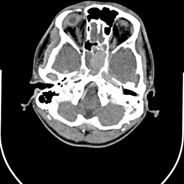 Nasopharyngeal carcinoma with skull base invasion (Radiopaedia 53415-59705 A 16).jpg