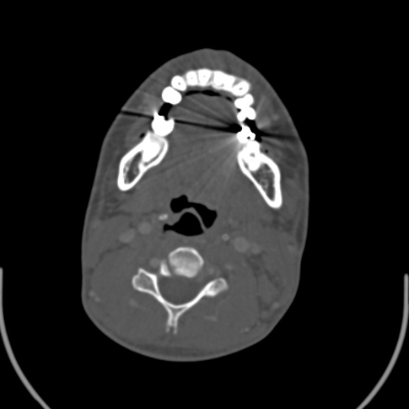 Nasopharyngeal carcinoma with skull base invasion (Radiopaedia 53415-59705 Axial bone window 113).jpg