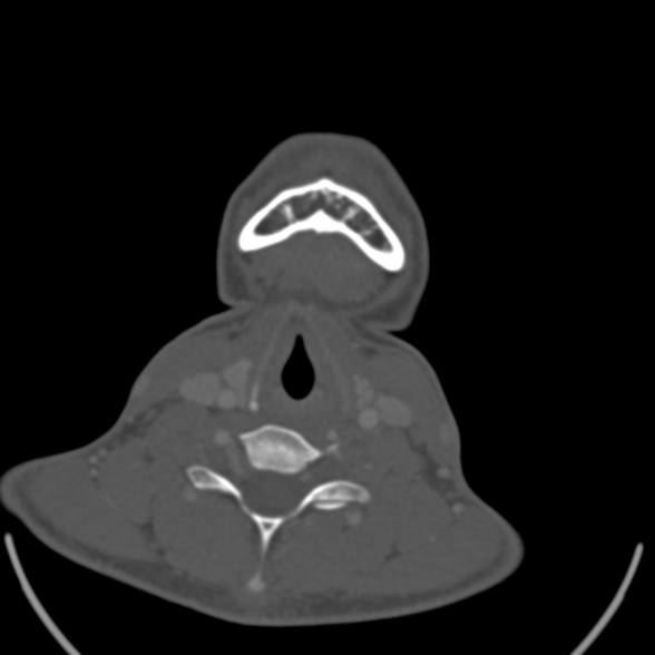 Nasopharyngeal carcinoma with skull base invasion (Radiopaedia 53415-59705 Axial bone window 151).jpg