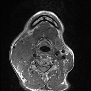 File:Nasopharyngeal carcinoma with skull base invasion (Radiopaedia 59258-66600 B 47).jpg