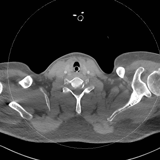 Neck CT angiogram (intraosseous vascular access) (Radiopaedia 55481-61945 B 139).jpg
