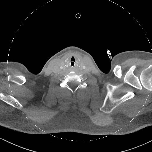File:Neck CT angiogram (intraosseous vascular access) (Radiopaedia 55481-61945 B 147).jpg