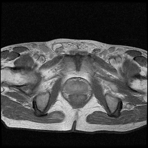 File:Necrotizing epididymo-orchitis with intra-testicular abscess (Radiopaedia 29397-29860 Axial T1 C+ 5).jpg