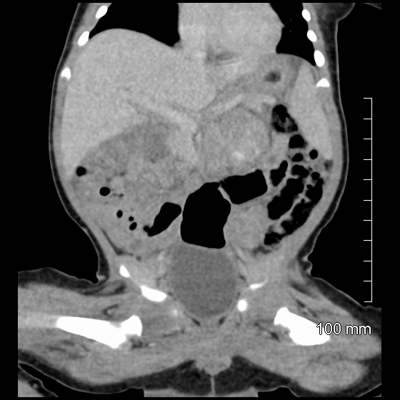 File:Neonatal neuroblastoma (Radiopaedia 56651-63438 Coronal non-contrast 25).jpg