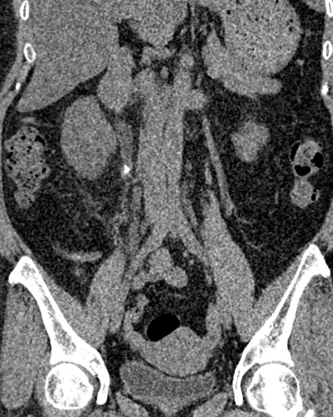File:Nephrostomy for urosepsis (Radiopaedia 26180-26330 non-contrast 47).jpg