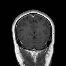 File:Neuro-Behcet's disease (Radiopaedia 21557-21505 Coronal T1 C+ 18).jpg