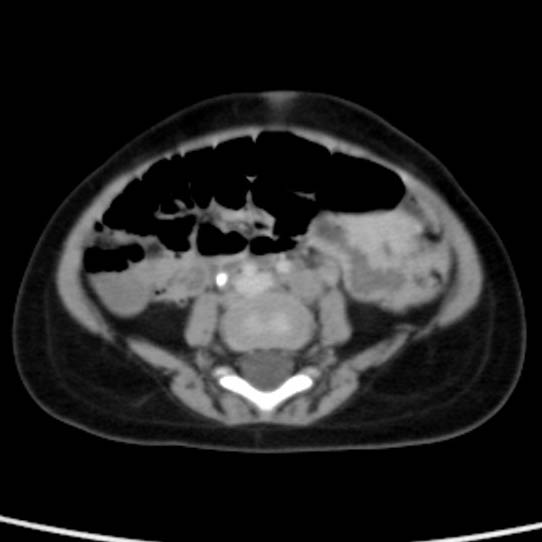 Neuroblastoma with skull metastases (Radiopaedia 30326-30960 C 39).jpg