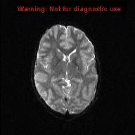 File:Neurofibromatosis type 1 with optic nerve glioma (Radiopaedia 16288-15965 Axial DWI 12).jpg