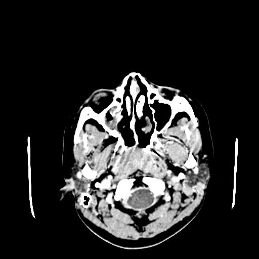 File:Neurofibromatosis type 2 (Radiopaedia 25389-25637 Axial C+ 1).jpg