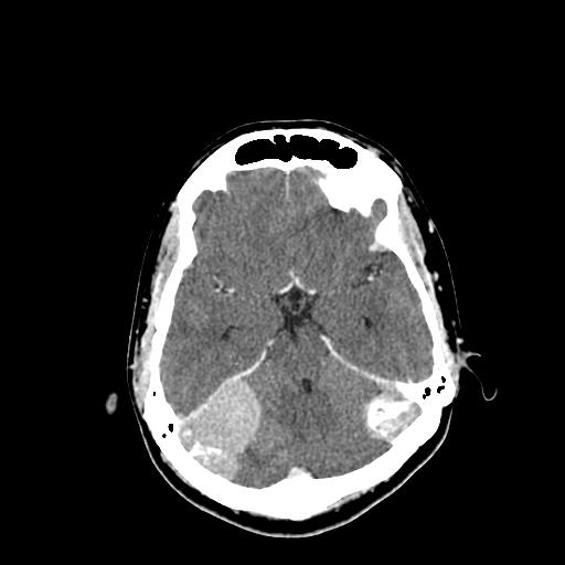 File:Neurofibromatosis type 2 (Radiopaedia 25389-25637 Axial C+ 27).jpg