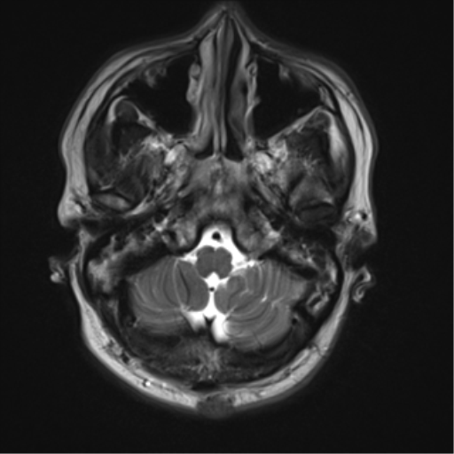 File:Neurofibromatosis type 2 (Radiopaedia 44936-48838 Axial T2 3).png