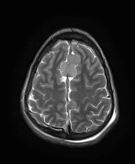 File:Neurofibromatosis type 2 (Radiopaedia 66211-75401 Axial T2 23).jpg