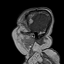 File:Neurofibromatosis type 2 (Radiopaedia 8713-9518 Sagittal T1 C+ 6).jpg