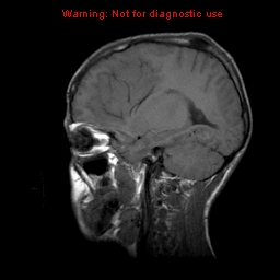 File:Neurofibromatosis type 2 (Radiopaedia 8953-9730 Sagittal T1 7).jpg