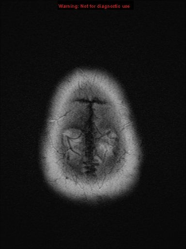 File:Neuroglial cyst (Radiopaedia 10713-11184 Axial T2 1).jpg