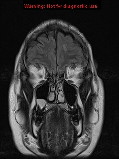 File:Neuroglial cyst (Radiopaedia 10713-11184 Coronal FLAIR 21).jpg