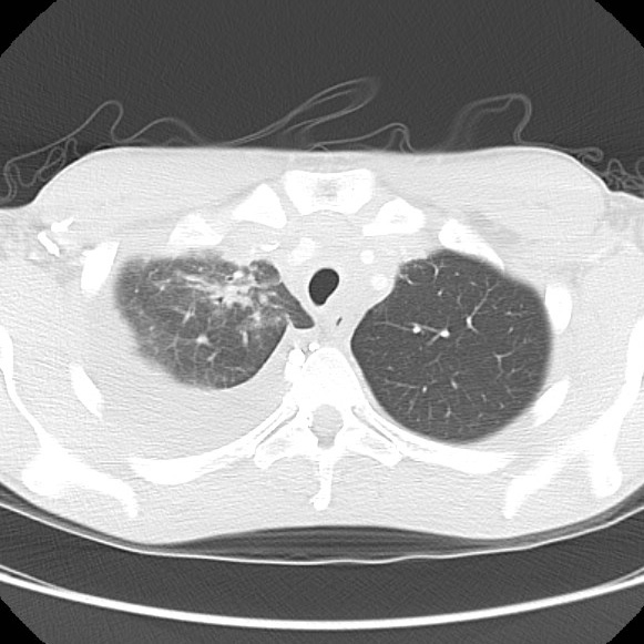 File:Non-Hodgkin lymphoma involving lung (Radiopaedia 29094-29470 Axial lung window 17).jpg