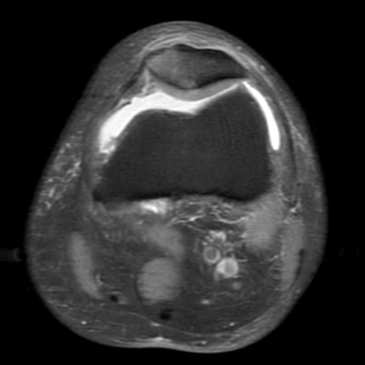 File:Non-displaced patella fracture (Radiopaedia 15932-15582 Axial PD fat sat 7).jpg