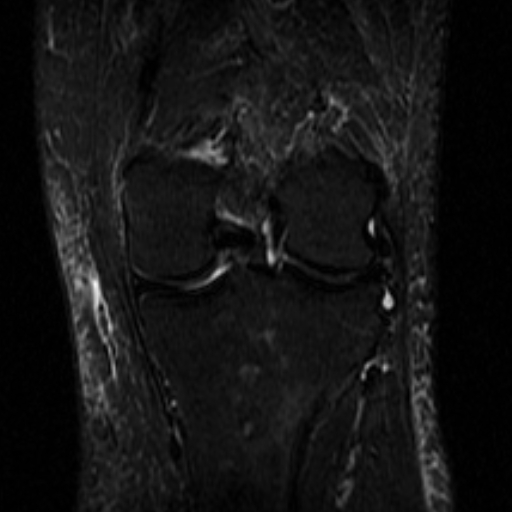 File:Non-displaced patella fracture (Radiopaedia 15932-15582 Coronal STIR 15).jpg