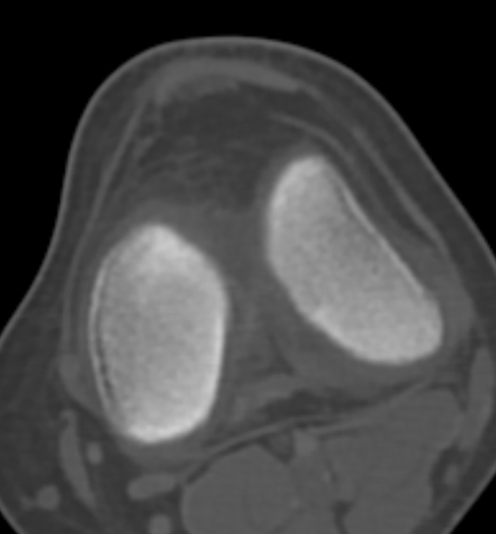 Non-ossifying fibroma - femur (Radiopaedia 82786-97042 Axial bone window 58).jpg