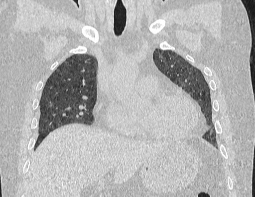Non specific interstitial pneumonia (NSIP) (Radiopaedia 89725-106798 Coronal lung window 30).jpg