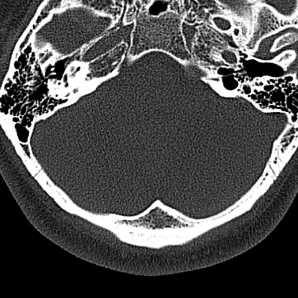 File:Normal CT of the cervical spine (Radiopaedia 53322-59305 Axial bone window 10).jpg